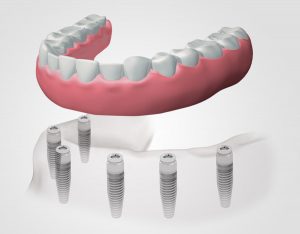 implantes dentales en Terrassa
