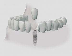 implantes dentales en Terrassa