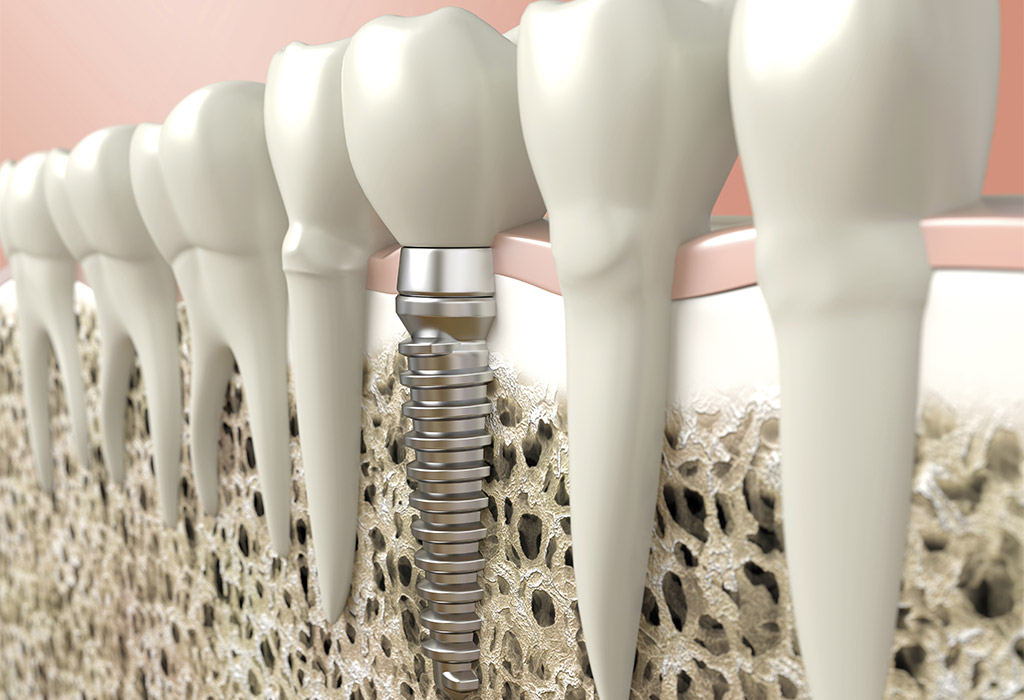 Implantología dental en Terrassa