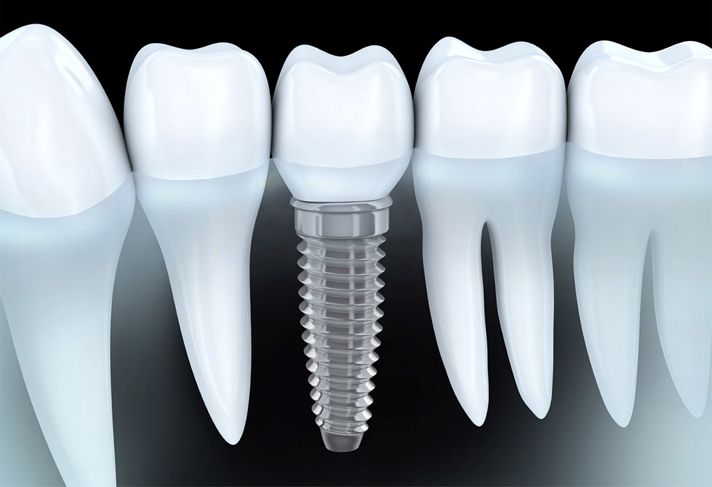 Implantología dental en Terrassa