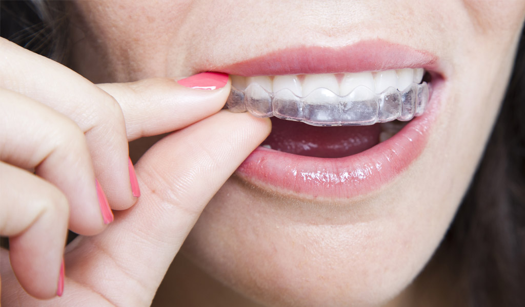 ortodoncia invisalign en Terrassa