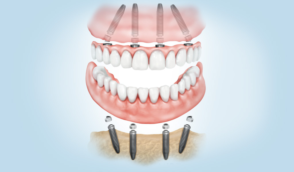 Implantes dentales en Terrassa