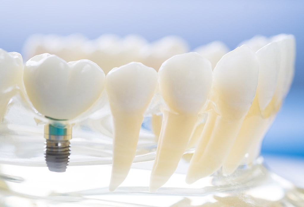 Cuidados de los implantes dentales en Terrassa