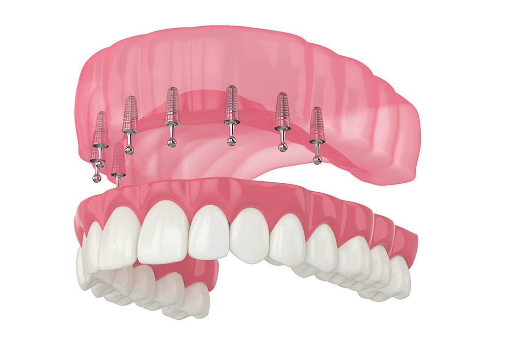 Prótesis fija sobre implantes dentales en Terrassa