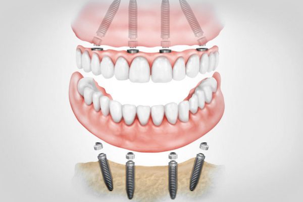 implantes-dentales-1dia