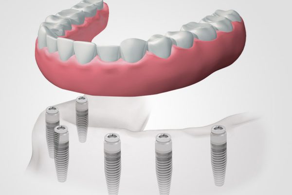 implantes-dentales-hibrida